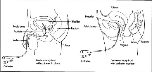 How Catheter Is Made Material History Used Structure Procedure Product Industry Machine History